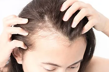 Female Pattern Hair Loss